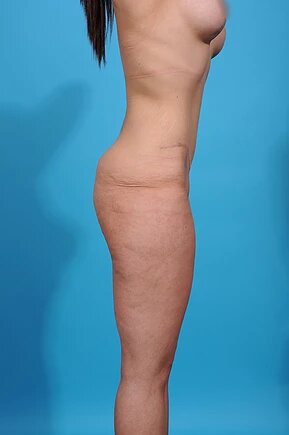 after abdominoplasty right side view female patient case 1005