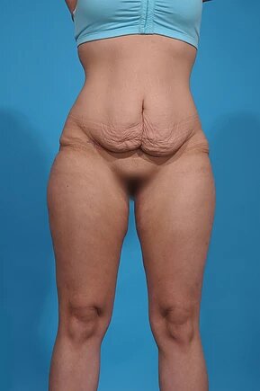 before abdominoplasty front view female patient case 1005