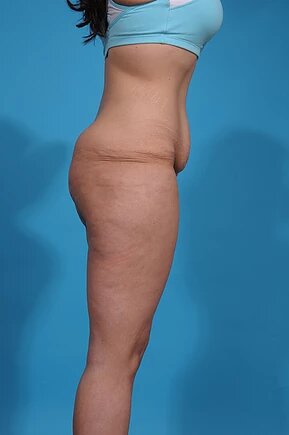 before abdominoplasty right side view female patient case 1005