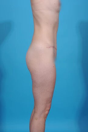 after abdominoplasty right side view female patient case 1010