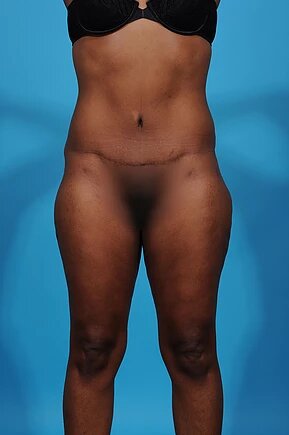 after abdominoplasty front view female patient case 1015