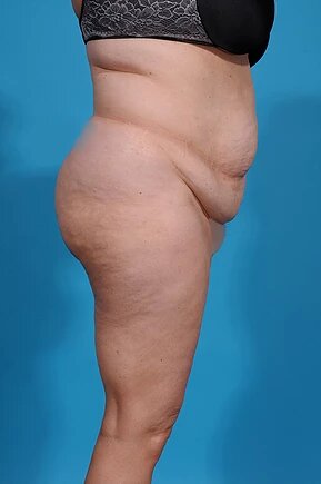 before abdominoplasty right side view female patient case 980