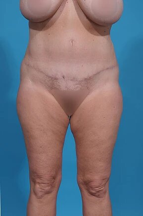 after abdominoplasty front view female patient case 980