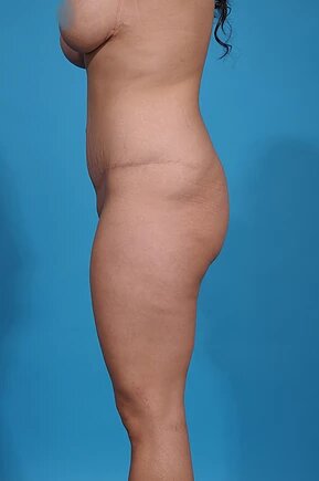 after abdominoplasty left side view female patient case 990