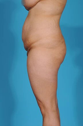before abdominoplasty left side view female patient case 990