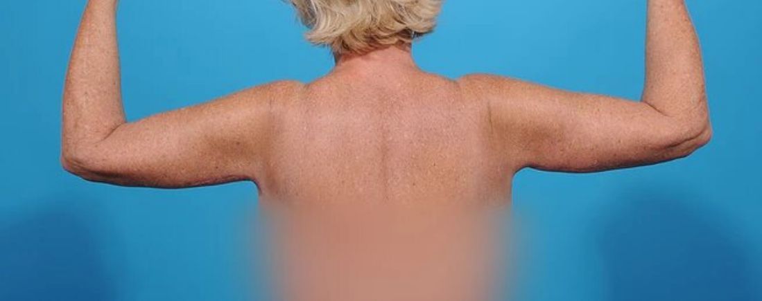 after arm lift back view female patient case 1201
