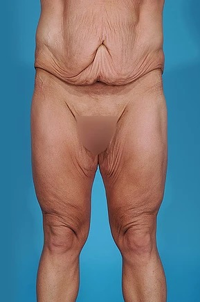 before body lift front view male patient case 686