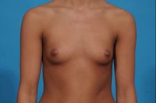 before breast augmentation front view female patient case 700