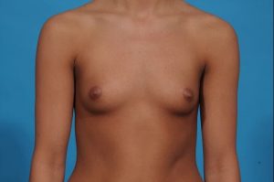 before breast augmentation front view female patient case 700