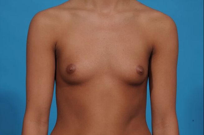 before breast augmentation front view female patient case 700