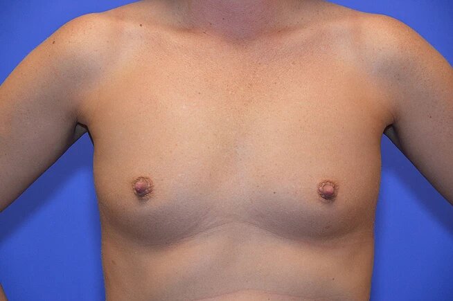 before breast augmentation front view female patient case 764