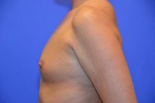 before breast augmentation left side view female patient case 764