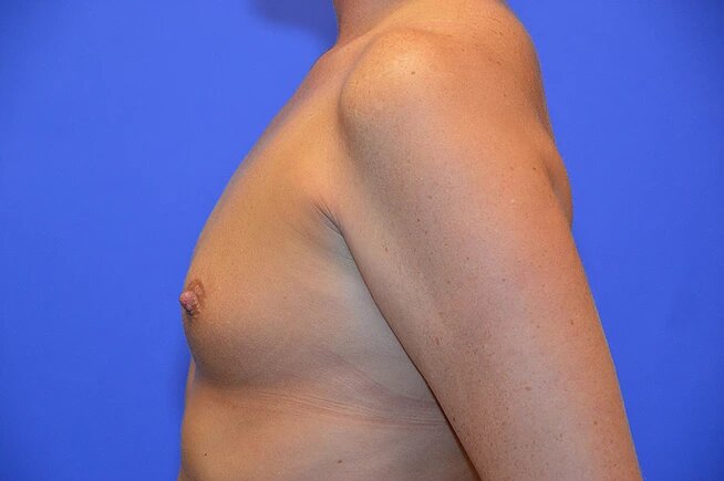 before breast augmentation left side view female patient case 764