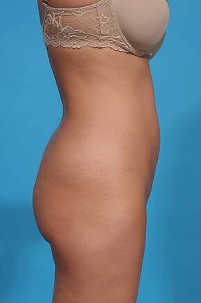 after liposuction right side view female patient case 955