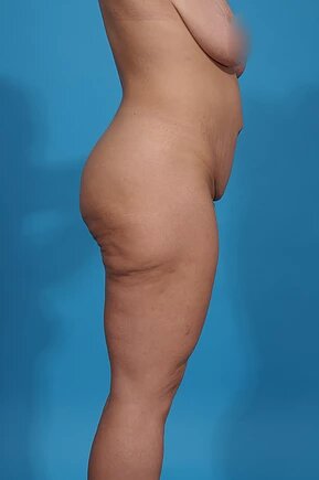 before thigh lift right side view female patient case 1191