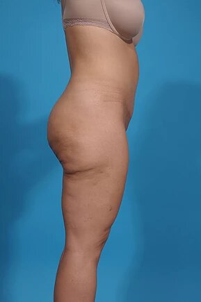 after thigh lift right side view female patient case 1191