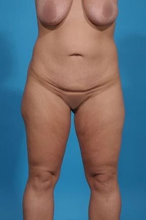 before thigh lift front view female patient case 1191