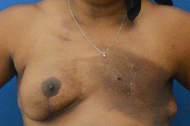 before breast reconstruction front view female patient case 2269