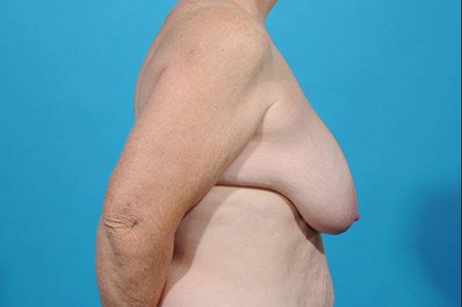 before breast reconstruction right view female patient case 2252