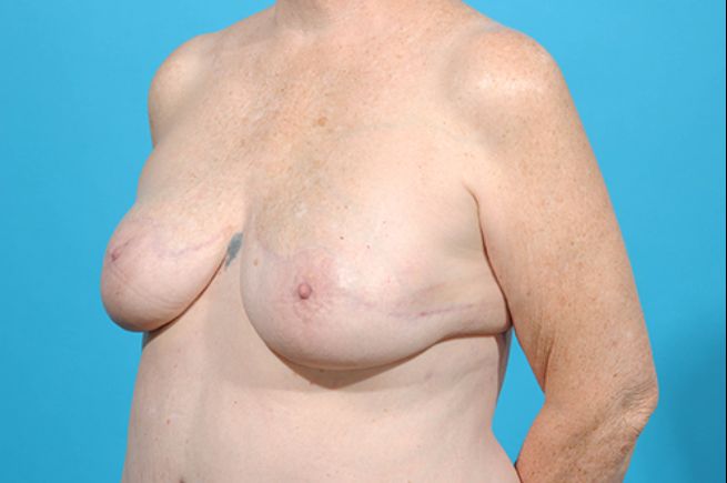 after breast reconstruction left angle view female patient case 2252