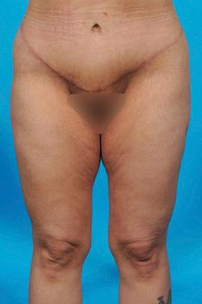 after abdominoplasty front view female patient case 2455