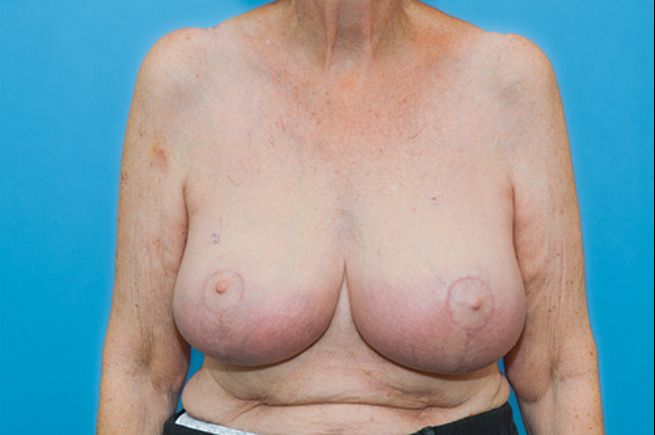 after breast reduction front view female patient case 2570