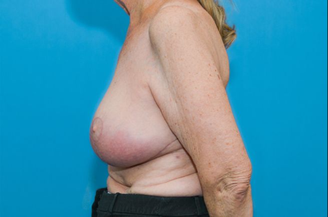 after breast reduction left side view female patient case 2570